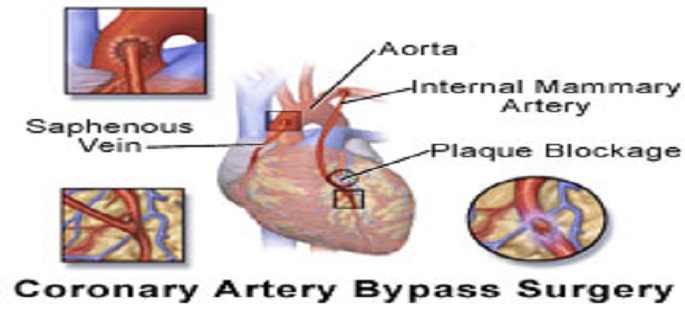 Coronary Artery Bypass Grafting Discharge Instruction Part1